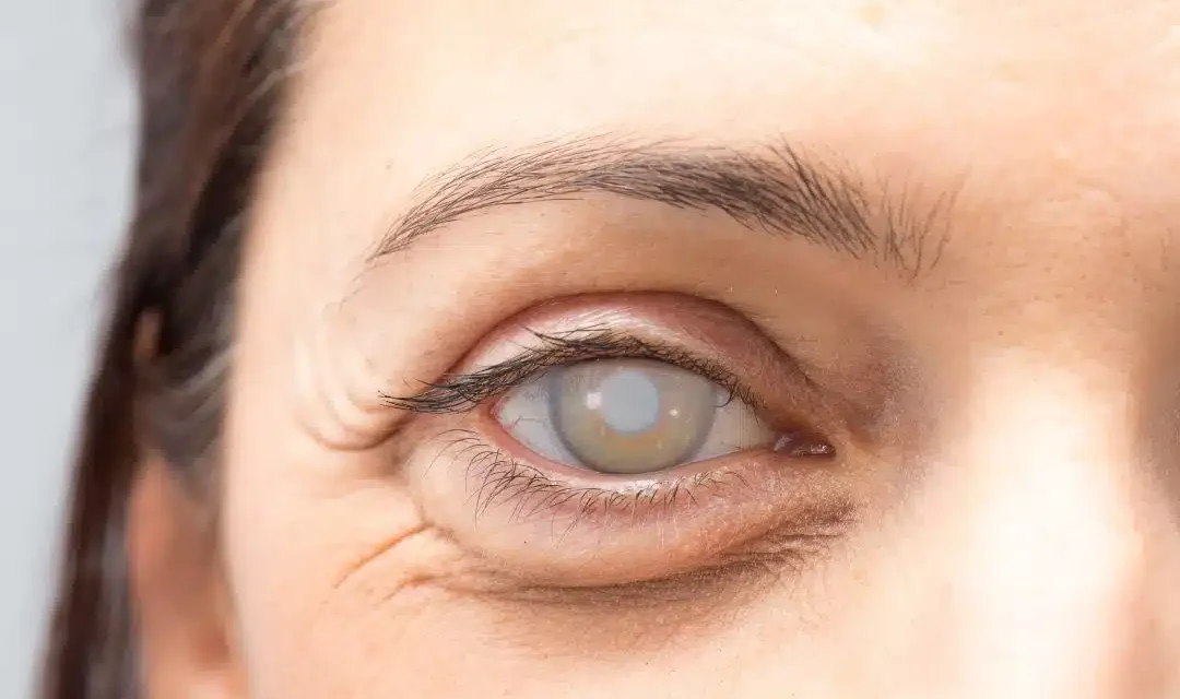 Penglihatan Mata Keruh Akibat Dari Kondisi Katarak