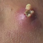 Penyakit Infeksi Kulit Salah Satunya Membuat Bisulan