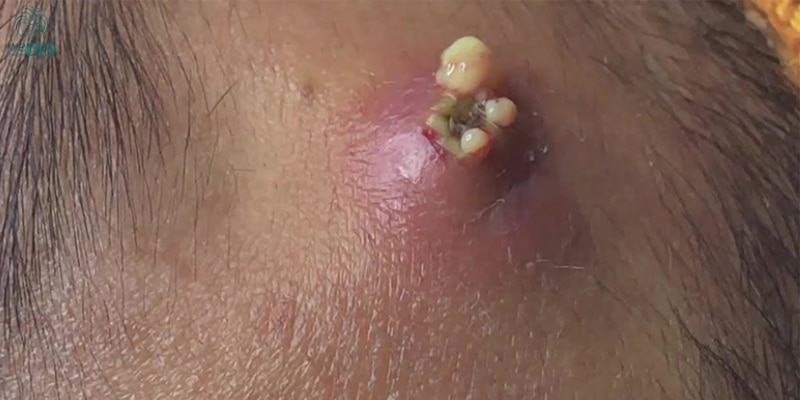 Penyakit Infeksi Kulit Salah Satunya Membuat Bisulan